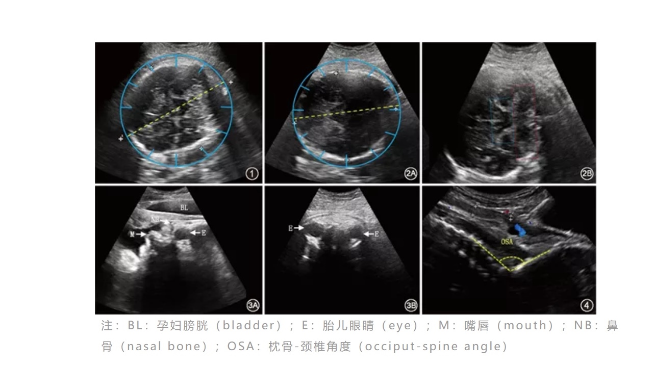 产程超声的各项指标的测量技术要点(一)_超声检查