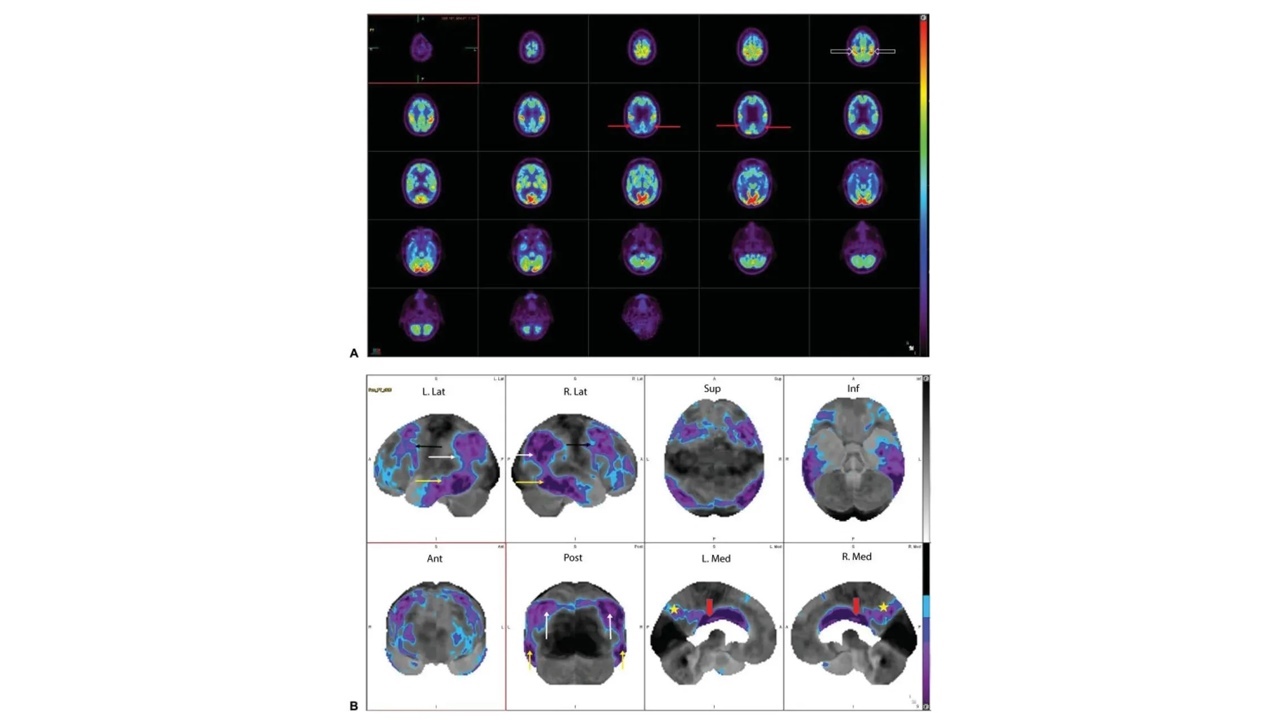 痴呆的影像学检查：𝞫淀粉样蛋白PET显像_痴呆